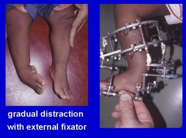 Clubfoot Talipes Treatment Management Approach Considerations Nonoperative Therapy Surgical Therapy