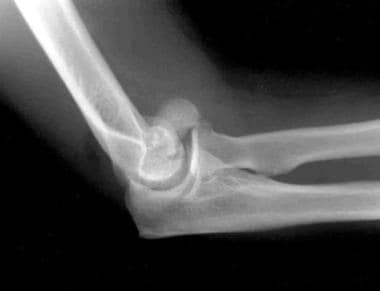 Lateral radiograph of a distal humerus fracture of