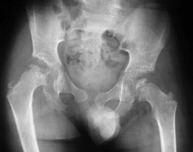 Anteroposterior (AP) radiograph of the pelvis show