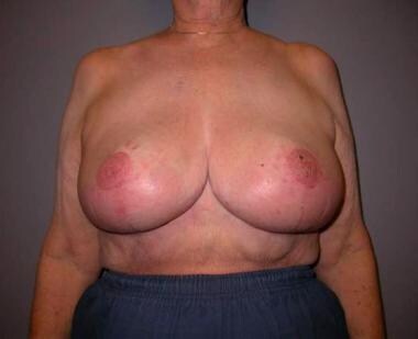 Postoperative photograph of the breasts of patient
