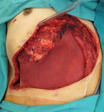Coverage of the open abdominal defect with a Parie