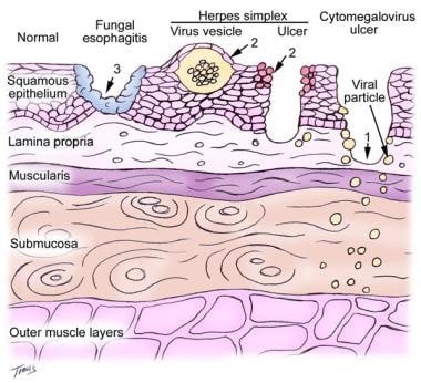 Esophagitis. Location of fungal and viral infectio