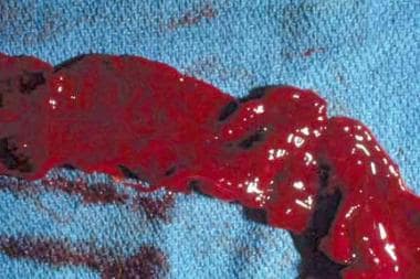 大体标本显示出血性死肠