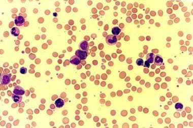 Peripheral smear of a patient with chronic myeloge