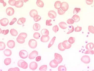 hemoglobin sc disease blood smear