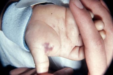 Lesions caused by Neisseria meningitis bacteremia 