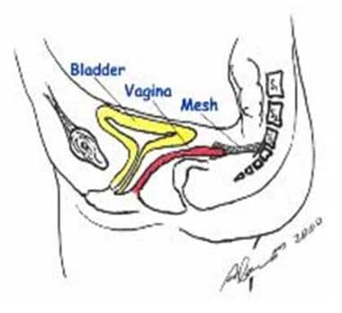 a) Normal pelvic support and (b) weakened pelvic support. Source