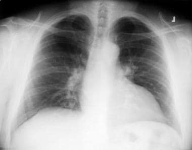 A chest radiograph with normal findings in a 64-ye