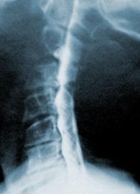 颈椎脊髓造影显示晚期脊椎病