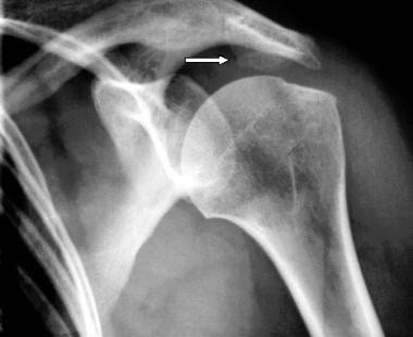 Presence of a bony spur on the inferior surface of