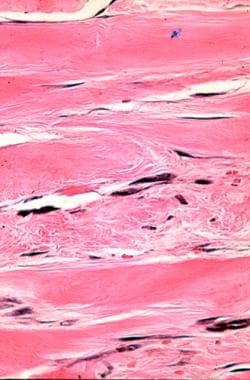 Skin biopsy showing severe fibrosis. The fibrosis 