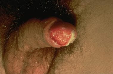 Penile cancer. Squamous cell carcinoma (Image cour
