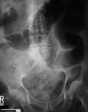 Radiograph of a 90-year-old man with abdominal pai