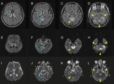 Wernicke Encephalopathy MRI