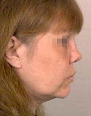 Woman (same patient as in image above) with a subt