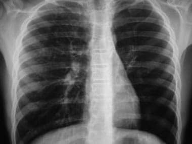 Congenital Lung Malformations. Hypovascularity of 