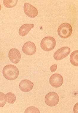 Peripheral smear from patient with hemoglobin H di