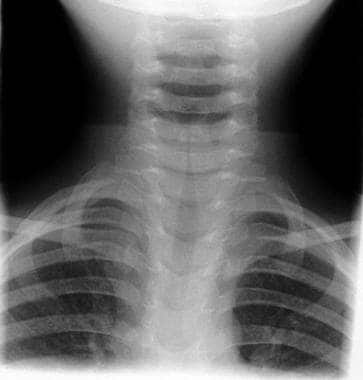 Steeple sign (trachea), Radiology Reference Article