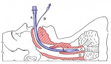 Diagram of an inserted endotracheal tube. Image co