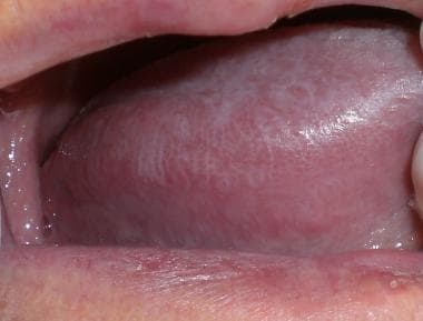 Lateral tongue in lichen planus. 