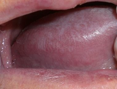 idiopathic leukoplakia