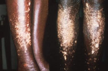 Skin of a West African person with leopard spot de