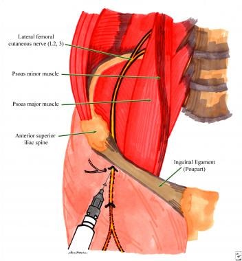 Lateral femoral cutaneous nerve block technique. S
