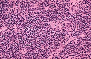 Histologic sections reveal a highly cellular neopl