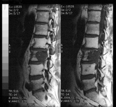 MRI scan demonstrates an osteolytic lesion involvi