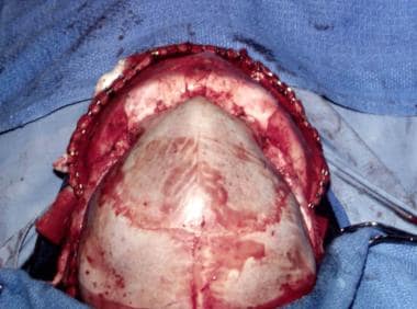 Metopic craniosynostosis. Appearance of skull from