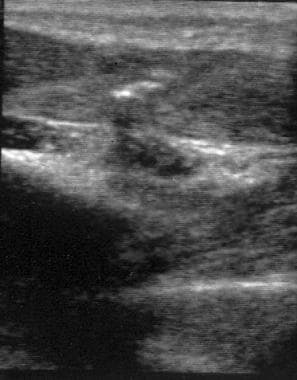 Ultrasound of remaining projectile foreign body fr