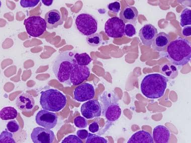Myelodysplastic syndrome with single lineage dyspl