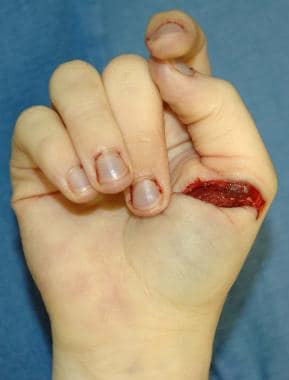 A defensive injury on the hand of a homicide victi