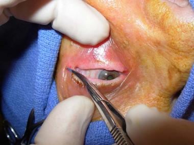 Eyelid has been anesthetized. Lateral canthotomy i