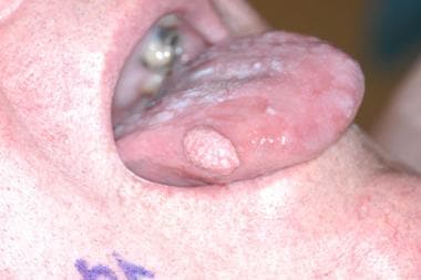 T1N0 SCC, right lateral tongue, 