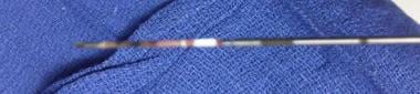 Tru-cut needle with pleural tissue sample obtained