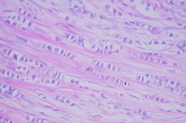 invasive ductal carcinoma histology