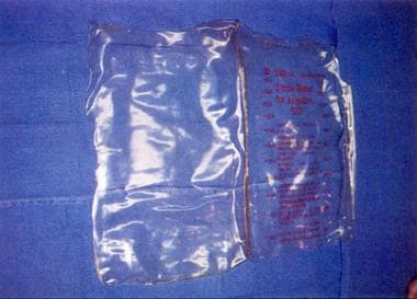 Presterilized 3-L cystoscopy irrigation bag. Court
