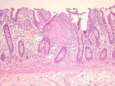 Granuloma in the mucosa of a Crohn disease patient