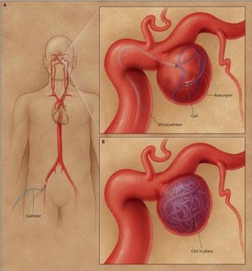 Endovascular coiling of cerebral aneurysm. Transfe