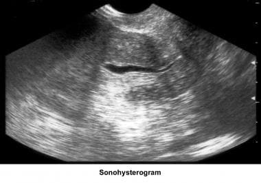 Infertility. Sonohysterogram. Image courtesy of Ja