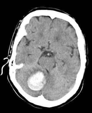 A 62-year-old female with hypertension presented w
