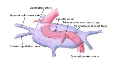 Carotid-cavernous fistula. Anatomic features are s