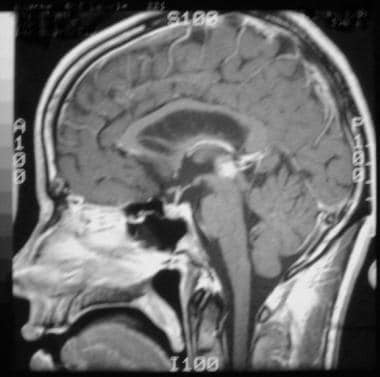 Pineal germinoma in a 30-year-old man. Sagittal T1