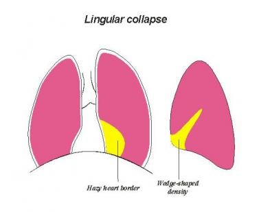 Image depicting the lingula collapsing medially. 