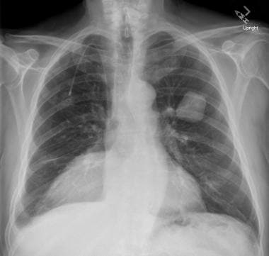 Chest radiograph in a 67-year-old man with a histo