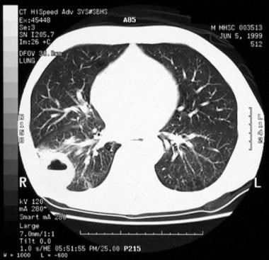 Non–small cell lung cancer. CT scan shows cavitati