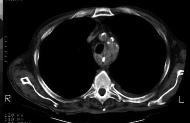 Nonenhanced axial CT image at the level of the ori