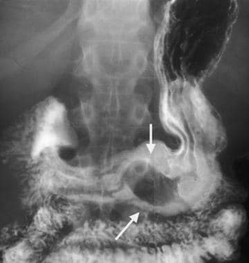 Gastric gastrointestinal stromal tumor (GIST) en f