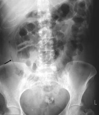 Plain abdominal radiograph in a 26-year-old with a